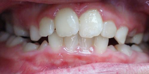 Zähne vor der Behandlung